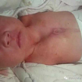 Chest wall of a one-month-old infant, with a noticeable depression in the upper chest wall that becomes more pronounced during inhalation