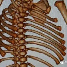 The 3D reconstruction reveals a missing bone structure in the midline of the anterior chest wall