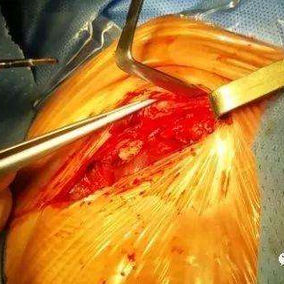 Right half of the sternal cleft