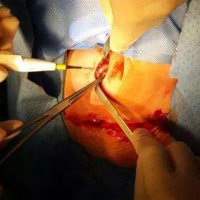 Two right ribs were resected partially