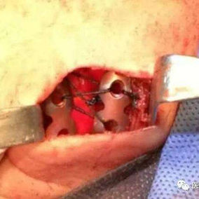 The rib defect was repaired using MatrixRIBs