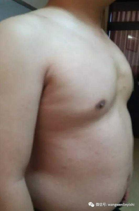 The entire upper chest wall protrudes forward, while the lateral wings and the middle-lower part are concave.