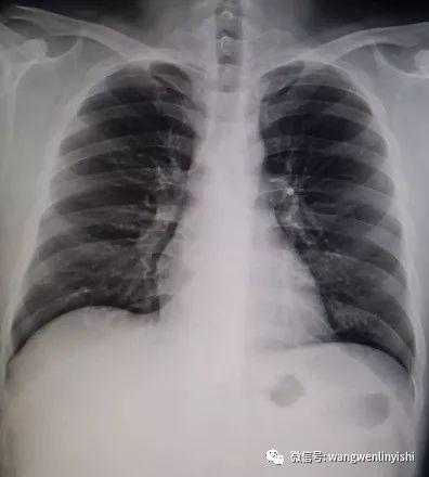 The X-ray indicates a slight rightward shift of the heart