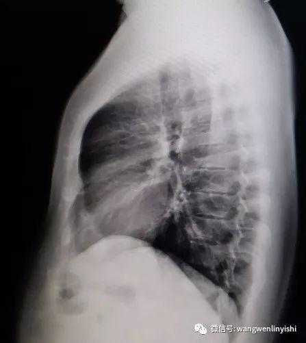The X-ray indicates a protrusion in the upper part of the anterior chest wall, with a depression below the middle portion.
