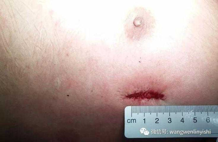 The 3 cm incision on the lateral chest wall