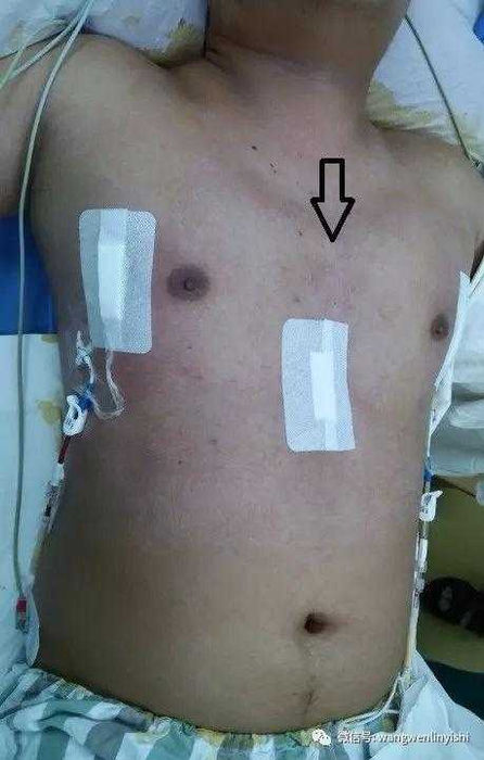 After the surgery, the chest wall appears normal with the  deformity eliminated