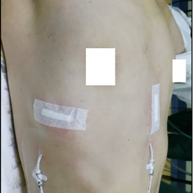 Post-operative appearance of the chest wall