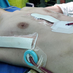 Postoperative chest wall appearance