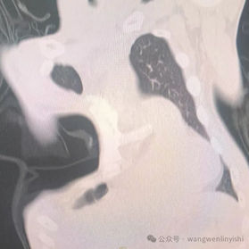 The anterior chest wall exhibits severe deformities.