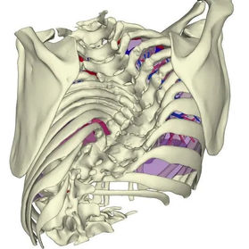 Spinal surgery is not feasible due to severe scoliosis.