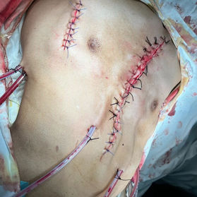 The postoperative appearance of the chest wall basically returned to normal.