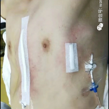 chest wall appearance after surgery
