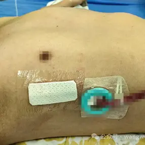 The appearance of the chest wall basically returned to normal after the surgery.