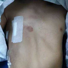 The chest wall appearance after the surgery