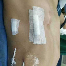 The chest wall appearance after the surgery