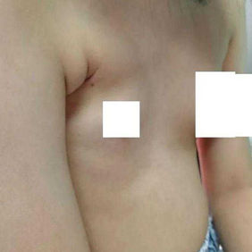 The chest wall is noticeably asymmetrical, with a pronounced indentation on the right side, accompanied by underdevelopment of the mammary glands and pectoral muscles