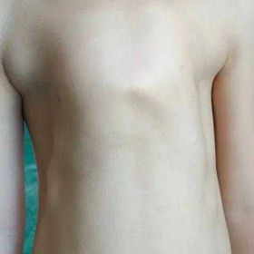 Severe chest wall deformity before the surgery