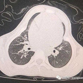 The cross-section of the chest has deviated from its normal shape, featuring a pronounced bulge in the center and concavities on either side.