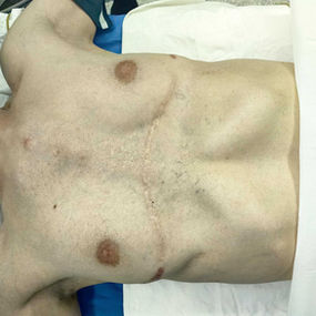 The chest wall shows a severe abnormality, featuring multiple old surgical scars, a large central depression, and prosthetic bulges on both sides