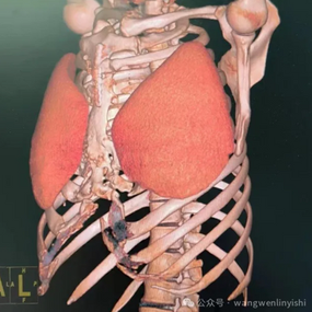 The prosthetics are positioned on the anterolateral chest wall, and there is significant narrowing of the thoracic cage along with restricted lung expansion