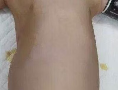 Surgery for A 9-month-old Child with Asphyxiating Thoracic Dystrophy