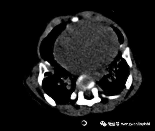 The CT image shows the chest wall structure protruding outward, resulting in an overall convex appearance.