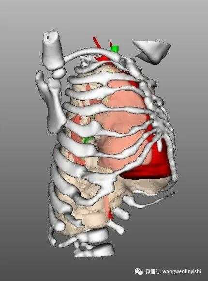 The 3D reconstruction depicting severe chest wall deformity.
