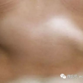 The left costal arch is protruding, while the right side is flat, with depressions on both sides of the lower chest wall