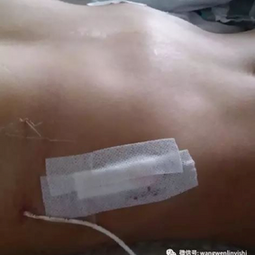 The chest wall appearance after the surgery