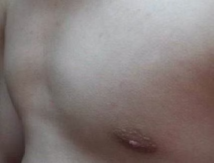 Minimally Invasive Surgery for a 30-Year-Old Male Patient with Saddle Chest