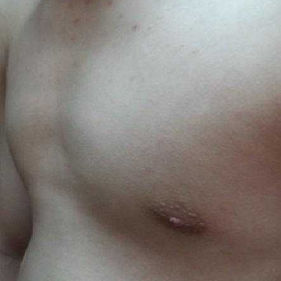 Preoperative chest wall appearance