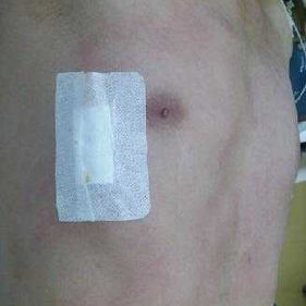 Postoperative chest wall appearance