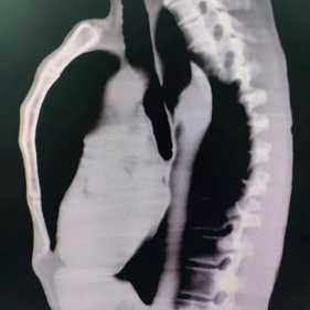 The CT scan shows a protruding anterior chest wall