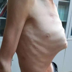 The anterior chest wall protrudes severely