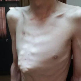 The chest wall appearance before the surgery