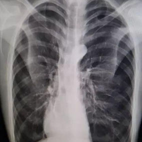 The X-ray shows the heart is displaced to the right
