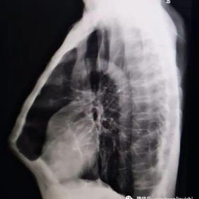 The X-ray shows a severe protrusion of the anterior chest wall, which forms a 90-degree angle at the xiphoid process