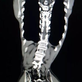The CT scan shows the torso is severely deformed