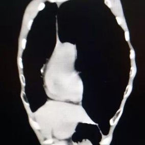 The CT scan shows a pronounced chest wall deformity, with the heart is displaced to the right