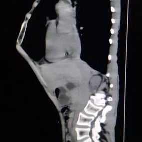 The CT scan shows a pronounced protrusion of the sternum, with slight changes in the natural curves of the spinal column