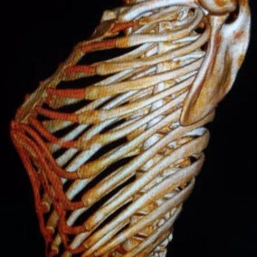 The 3D reconstruction shows a significant protrusion of the anterior chest wall, with a peak-like appearance and the xiphoid process as the highest point