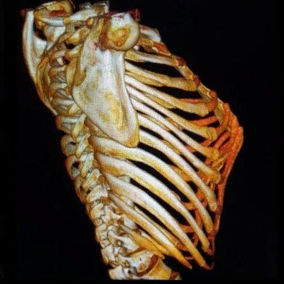 The 3D reconstruction shows a pronounced forward protrusion of the anterior chest wall, with a peak-like appearance and the xiphoid process as the highest point