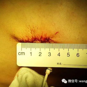 Only two small 3 cm incisions were made during the surgery