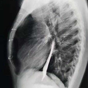 The chest wall exhibits a pronounced protrusion, and the sternum fixation wires can be seen