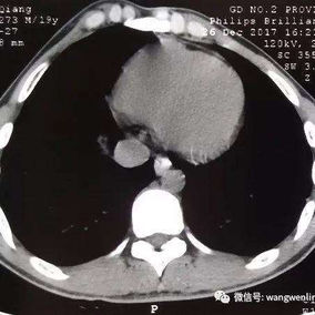 The preoperative CT scan shows a severely protruding anterior chest wall