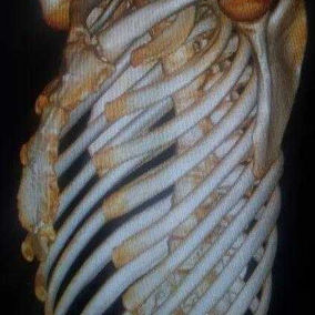 The preoperative 3D Reconstruction shows an overall protrusion of the sternum with a depression in the lower chest wall