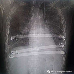 The postoperative X-ray shows the positions of the three bars