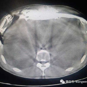 The postoperative CT scan shows the position of the bars