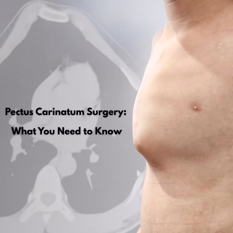Pectus Carinatum Surgery: What You Need to Know
