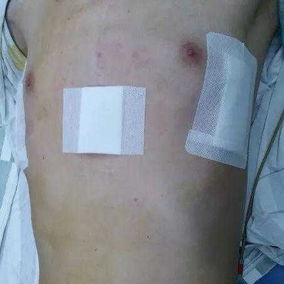 The chest wall deformity was eliminated after the surgery